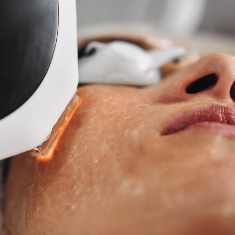 Photorajeunissement IPL